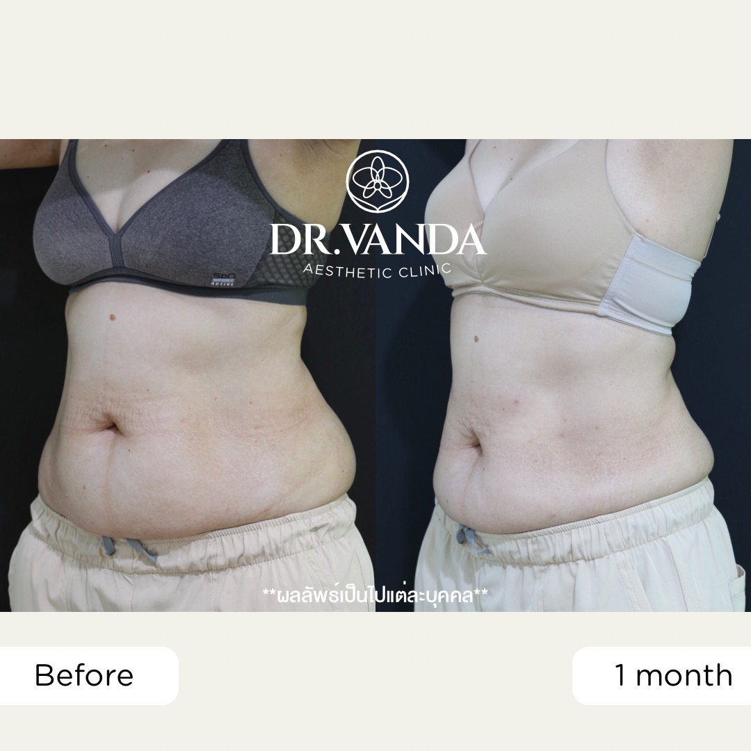 ก่อน-หลัง จัสตุรัส – คุณก้อย1