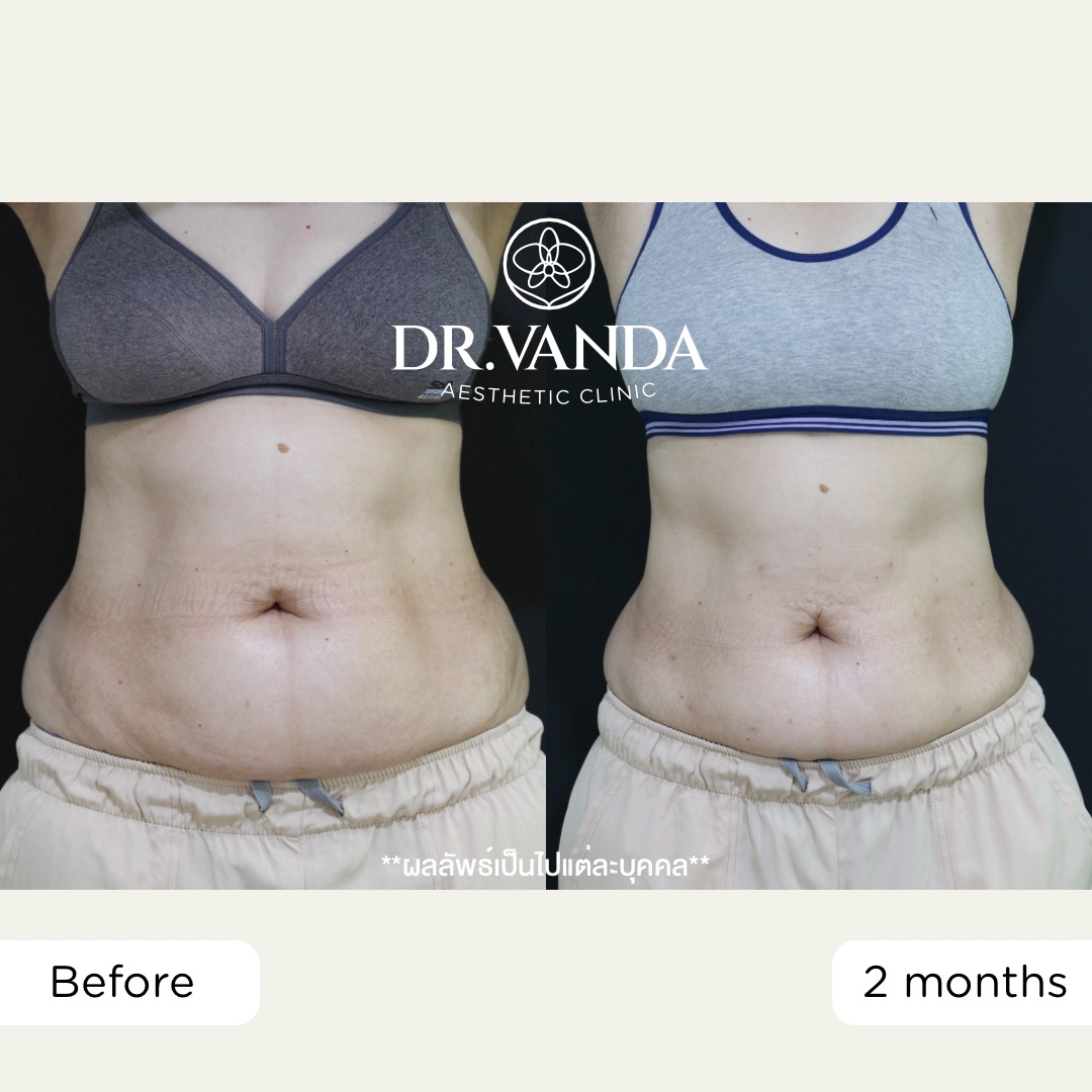 ก่อน-หลัง จัสตุรัส - คุณก้อย2