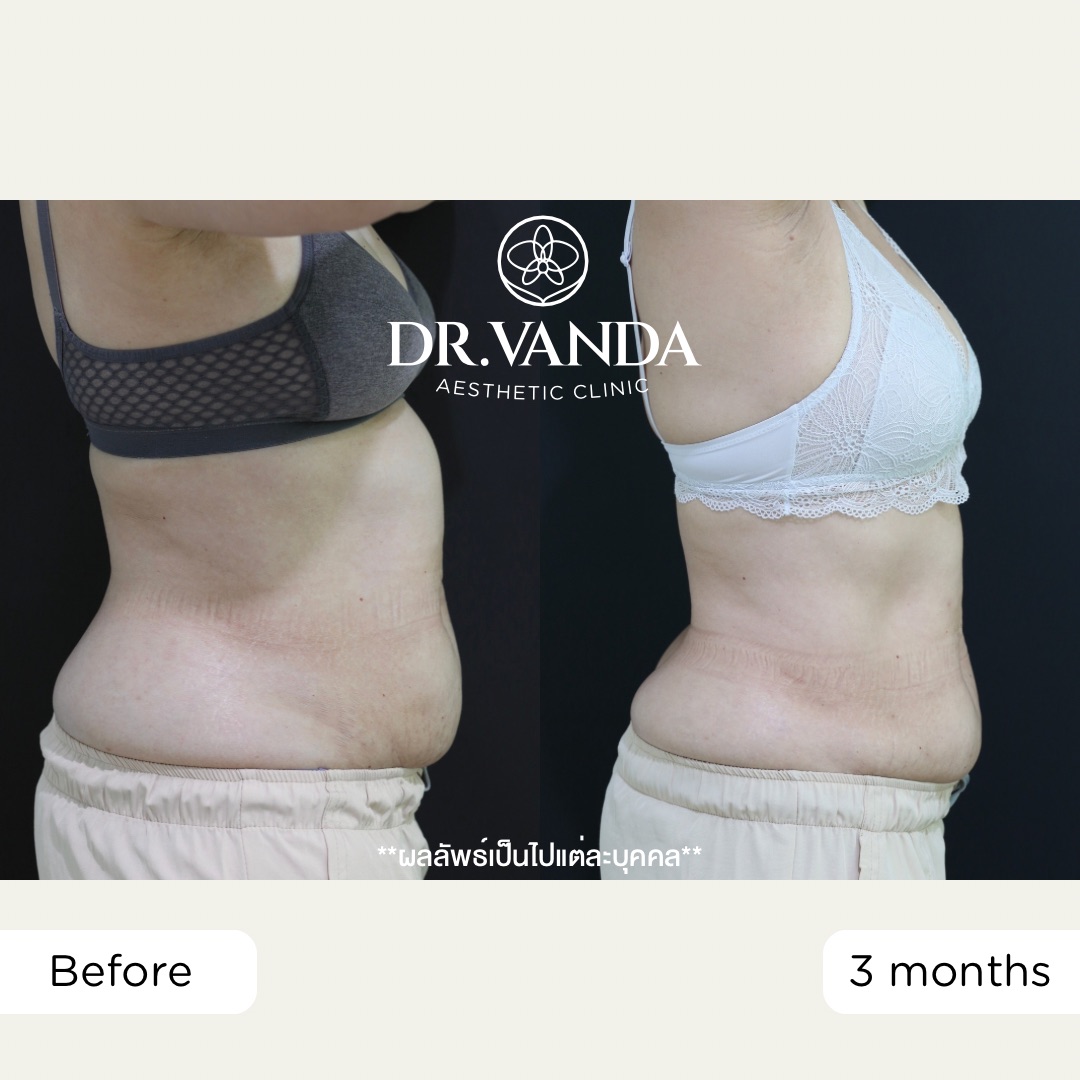 ก่อน-หลัง จัสตุรัส – คุณก้อย3