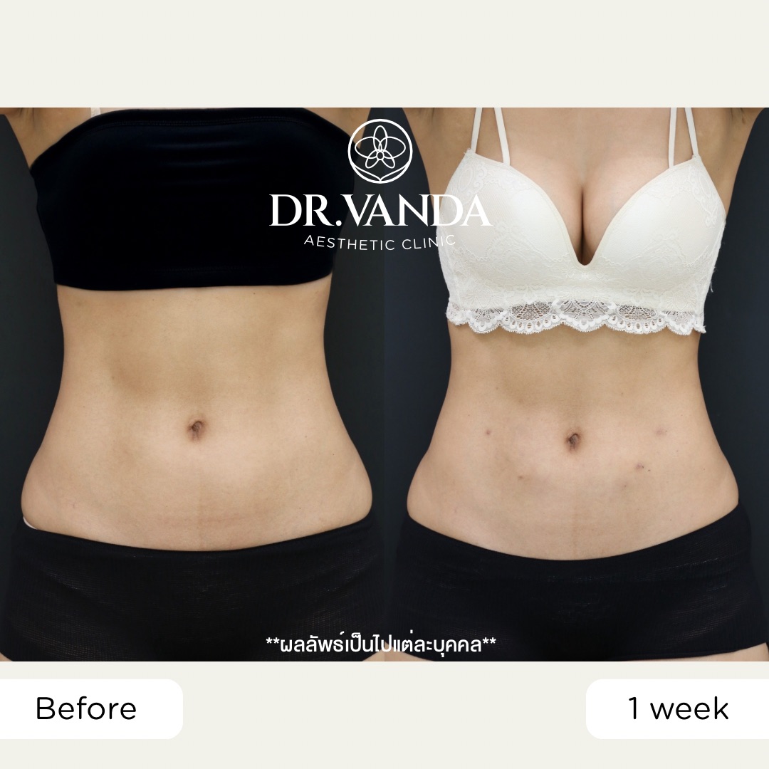 ก่อน-หลัง จัสตุรัส - คุณปิ่น2