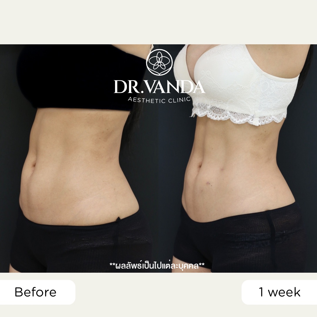 ก่อน-หลัง จัสตุรัส – คุณปิ่น3